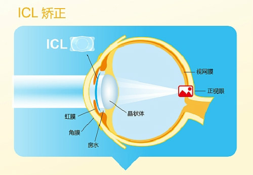 近视眼激光手术有哪些?专家告诉你哪种手术适合你