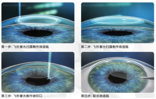 近视眼激光手术费用大概是多少钱？