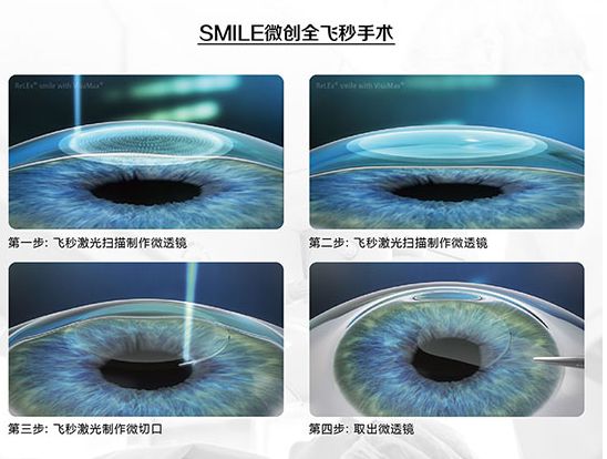 近视眼激光手术有哪些?专家告诉你哪种手术适合你
