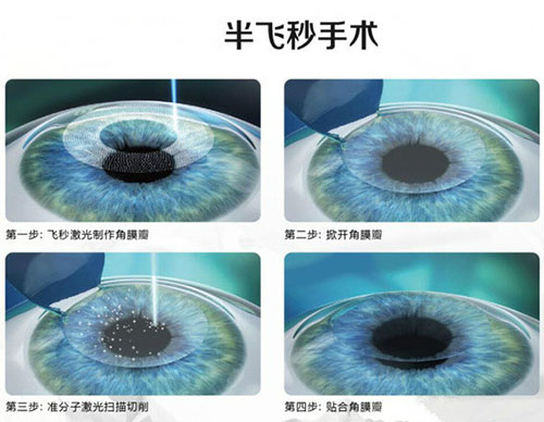 近视眼激光手术有哪些?专家告诉你哪种手术适合你