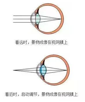 老花眼突然变好 需要警惕白内障