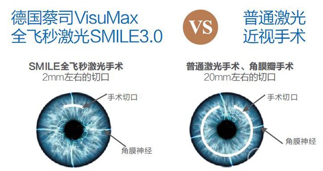 近视手术：蔡司VisuMax全飞秒激光SMILE3.0