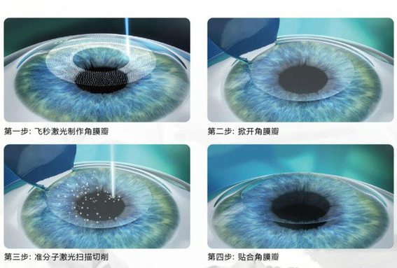近视眼激光手术详解:全飞秒和半飞秒有什么区别?